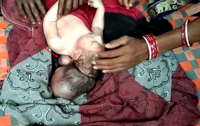Dianggap Suci, Bayi Sehat Berkepala Tiga Ini Lahir Dengan Selamat Dianggap Suci, Bayi Sehat Berkepala Tiga Ini Lahir Dengan Selamat